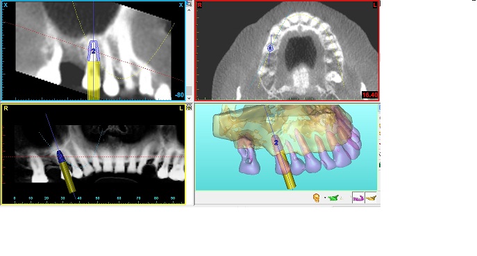 Planning a single implant tooth replacement